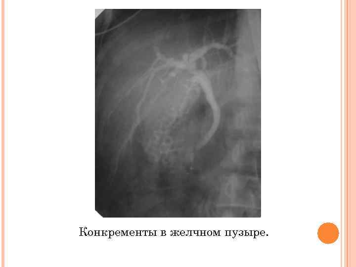 Конкременты в желчном пузыре. 