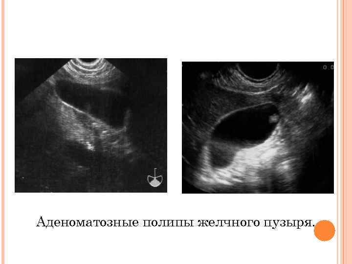 Аденоматозные полипы желчного пузыря. 