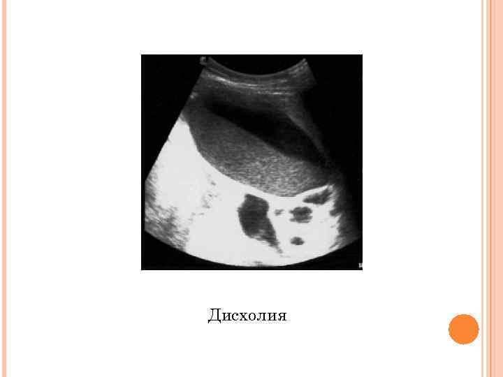 Дисхолия 