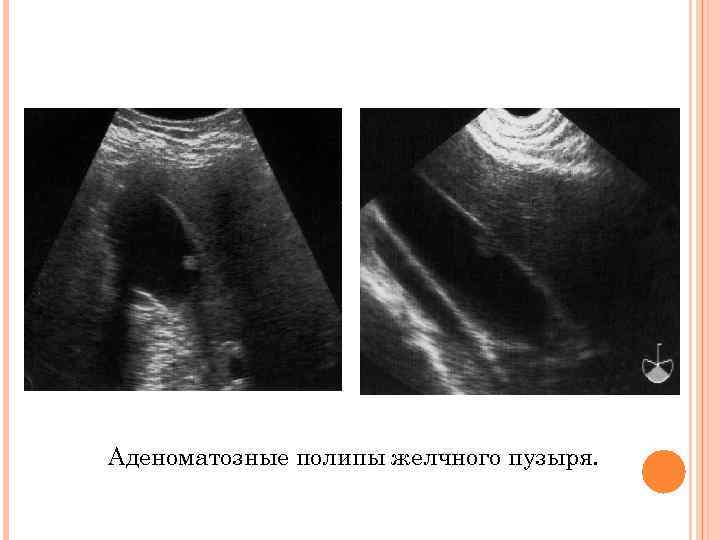 Аденоматозные полипы желчного пузыря. 
