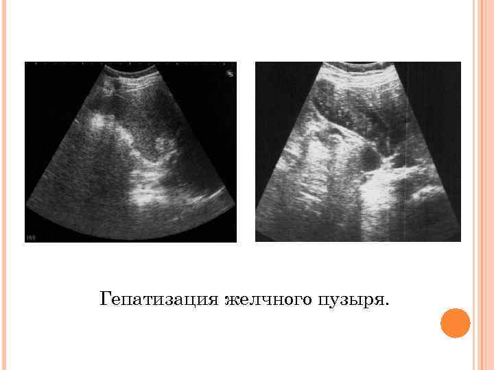 Гепатизация желчного пузыря. 