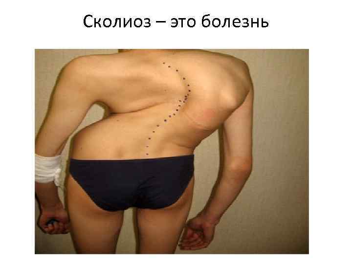 Сколиоз – это болезнь 