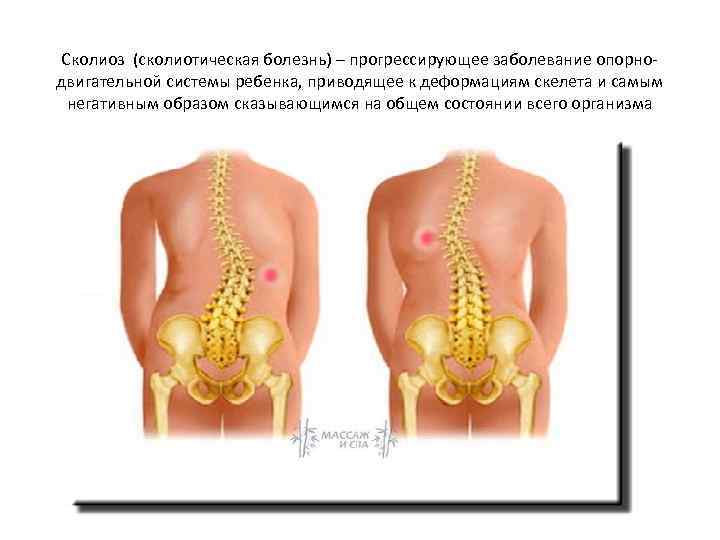 Сколиоз (сколиотическая болезнь) – прогрессирующее заболевание опорнодвигательной системы ребенка, приводящее к деформациям скелета и