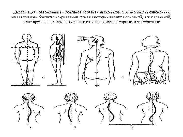 Схема массажа при сколиозе