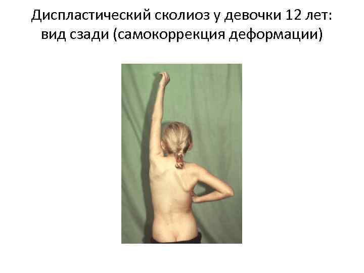 Диспластический сколиоз у девочки 12 лет: вид сзади (самокоррекция деформации) 
