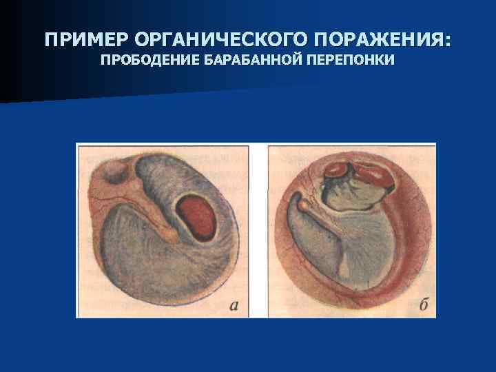 Прободение барабанной перепонки. Эластичности барабанной перепонки. Перфорация барабанной перепонки. Перфорация барабанной перепонки классификация.