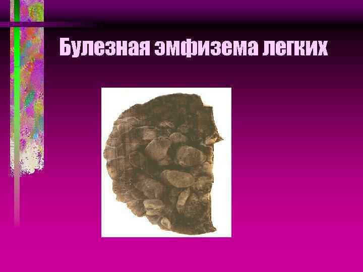 Булезная эмфизема легких 