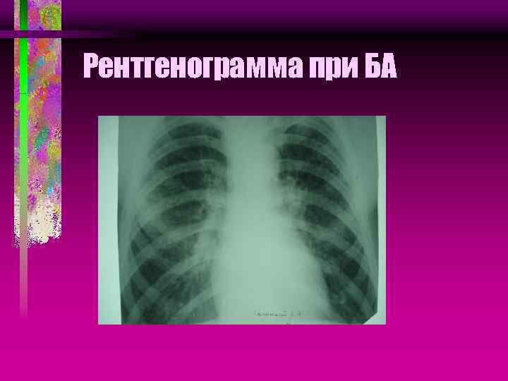 Рентгенограмма при БА 
