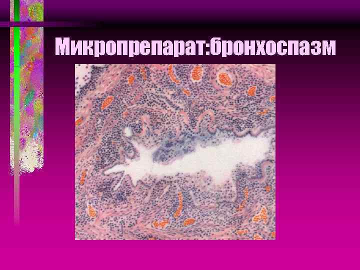 Микропрепарат: бронхоспазм 
