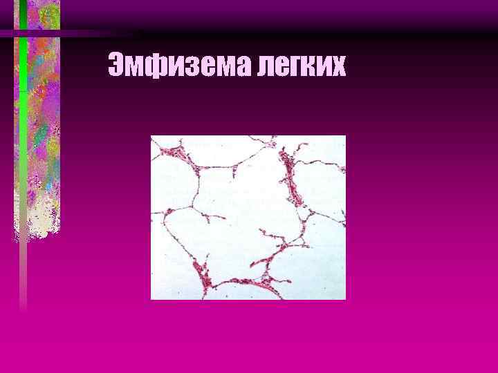 Эмфизема легких 