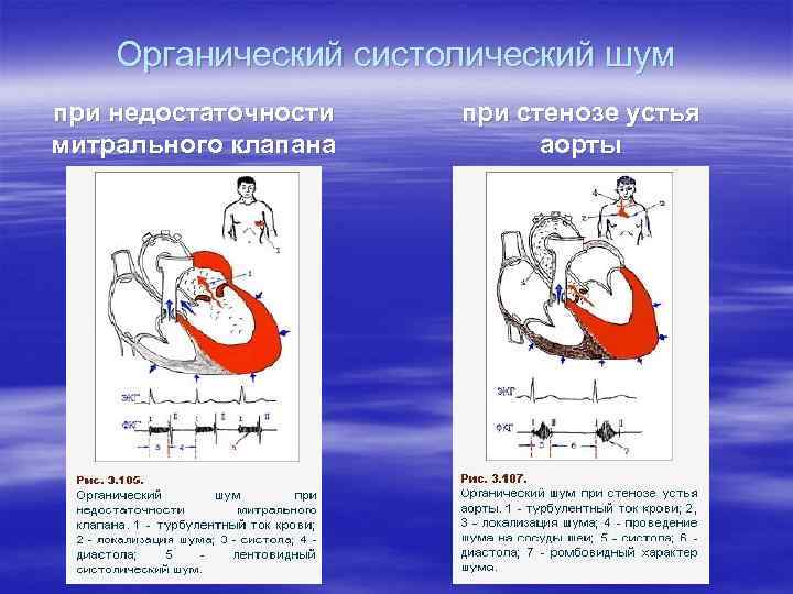 Органический систолический шум при недостаточности митрального клапана при стенозе устья аорты 