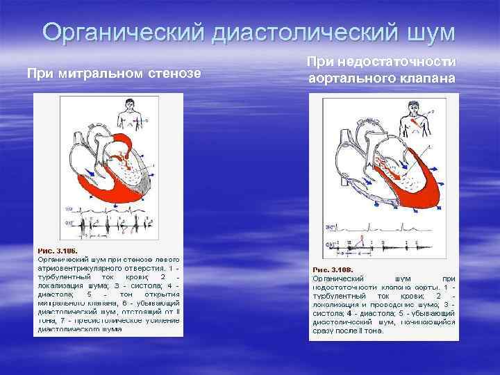 Органический диастолический шум При митральном стенозе При недостаточности аортального клапана 