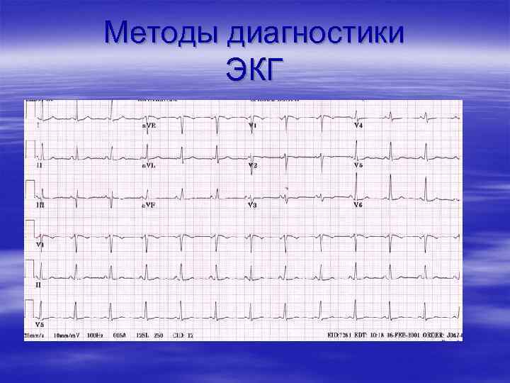 Методы диагностики ЭКГ 