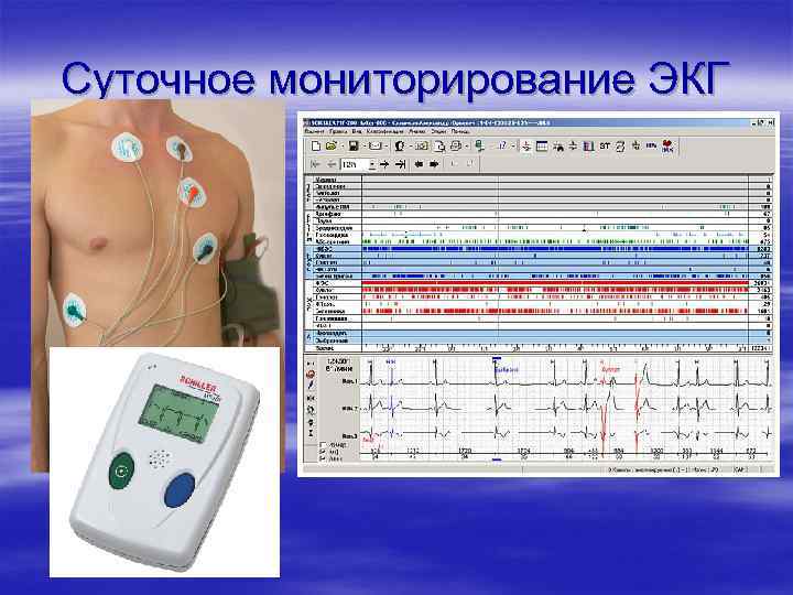 Суточное мониторирование ЭКГ 