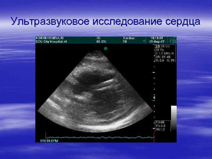 Ультразвуковое исследование сердца 