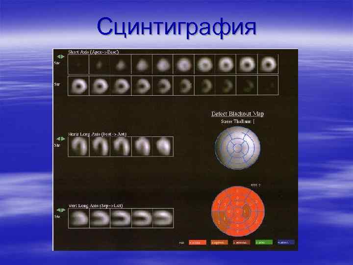 Сцинтиграфия 