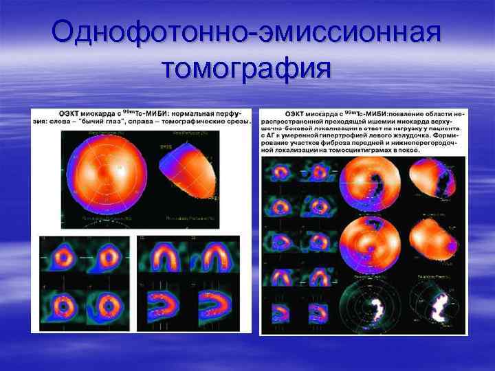 Однофотонно-эмиссионная томография 