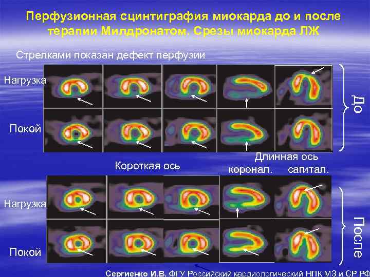 Перфузионная сцинтиграфия миокарда до и после терапии Милдронатом. Срезы миокарда ЛЖ Стрелками показан дефект