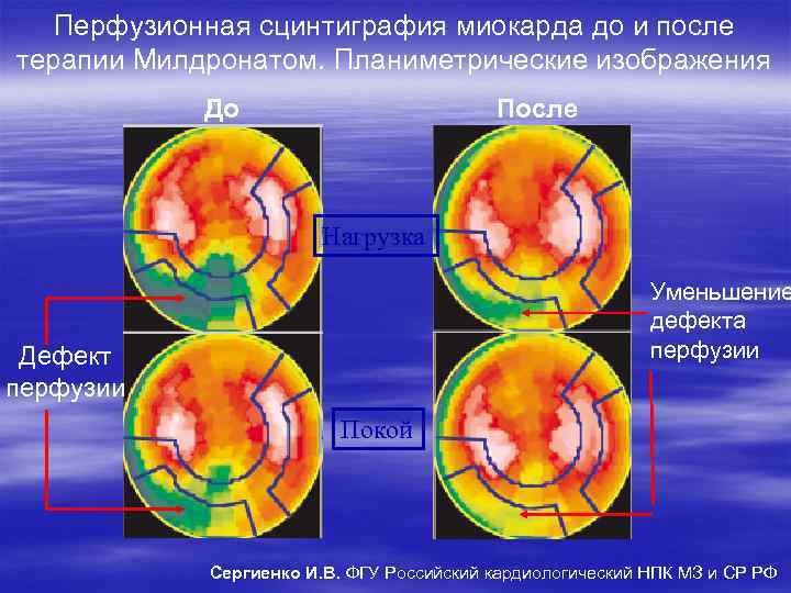Перфузионная сцинтиграфия миокарда до и после терапии Милдронатом. Планиметрические изображения До После Нагрузка Уменьшение