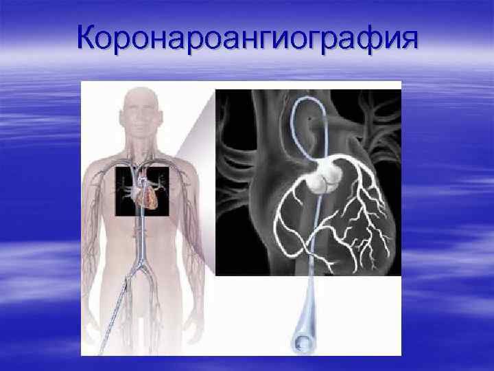Коронароангиография 