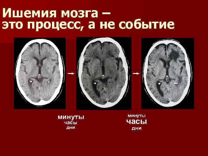 Ишемия мозга – это процесс, а не событие минуты часы дни 