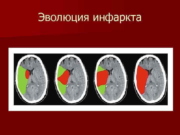 Эволюция инфаркта 