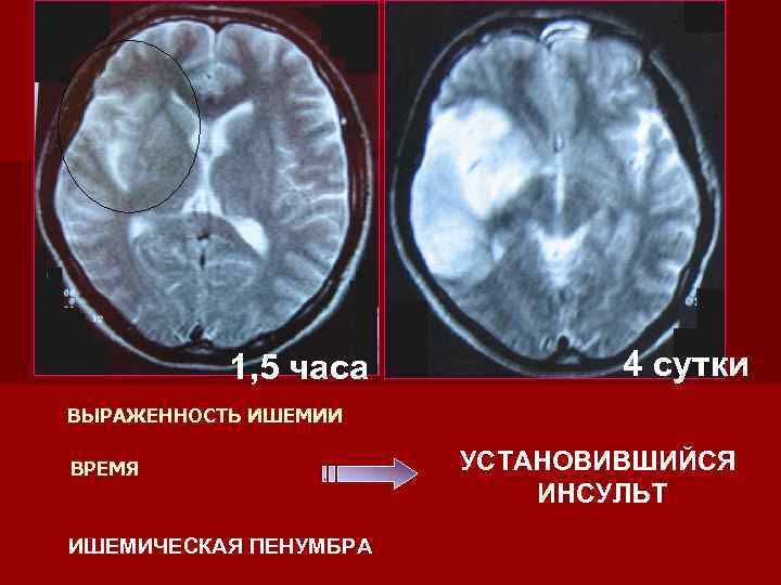 1, 5 часа 4 сутки ВЫРАЖЕННОСТЬ ИШЕМИИ ВРЕМЯ ИШЕМИЧЕСКАЯ ПЕНУМБРА УСТАНОВИВШИЙСЯ ИНСУЛЬТ 
