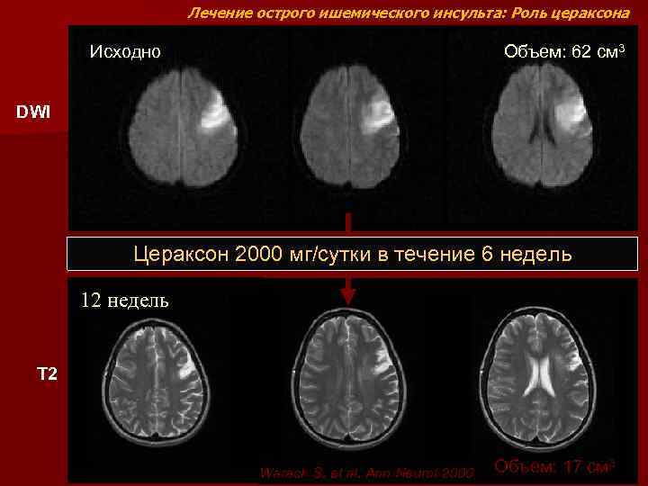 Лечение острого ишемического инсульта: Роль цераксона Исходно Объем: 62 см 3 DWI Цераксон 2000