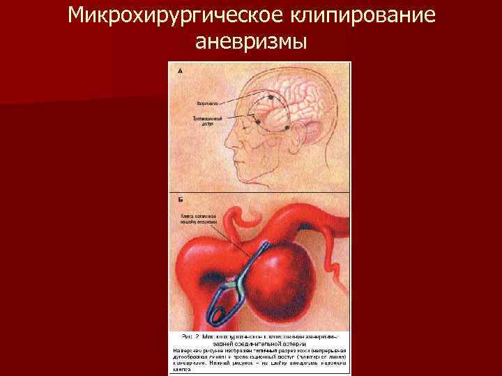 Микрохирургическое клипирование аневризмы 