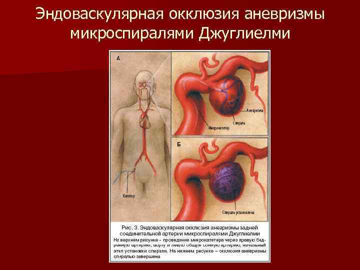 Эндоваскулярная окклюзия аневризмы микроспиралями Джуглиелми 