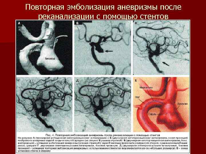 Повторная эмболизация аневризмы после реканализации с помощью стентов 