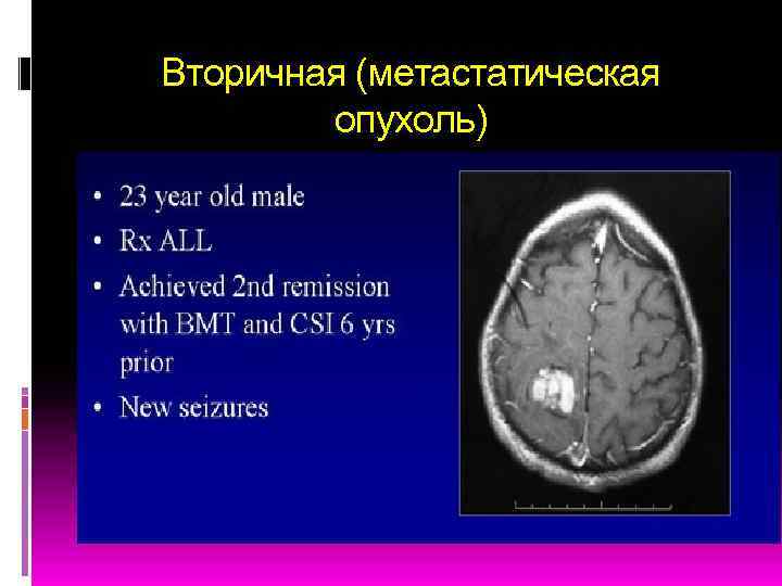 Вторичная (метастатическая опухоль) 