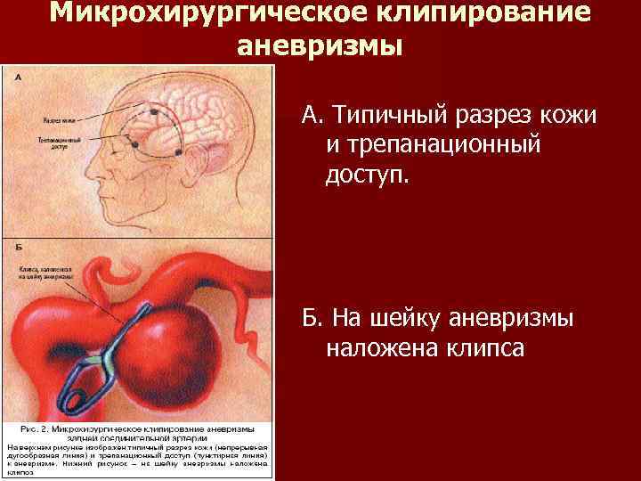 Микрохирургическое клипирование аневризмы А. Типичный разрез кожи и трепанационный доступ. Б. На шейку аневризмы