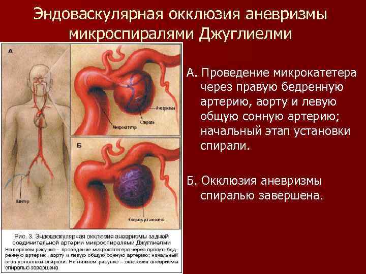 Эндоваскулярная окклюзия аневризмы микроспиралями Джуглиелми А. Проведение микрокатетера через правую бедренную артерию, аорту и