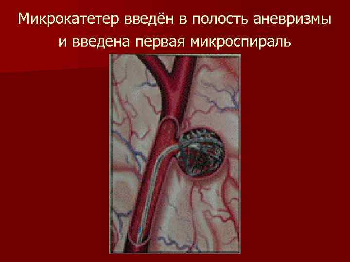 Микрокатетер введён в полость аневризмы и введена первая микроспираль 