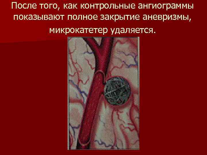 После того, как контрольные ангиограммы показывают полное закрытие аневризмы, микрокатетер удаляется. 