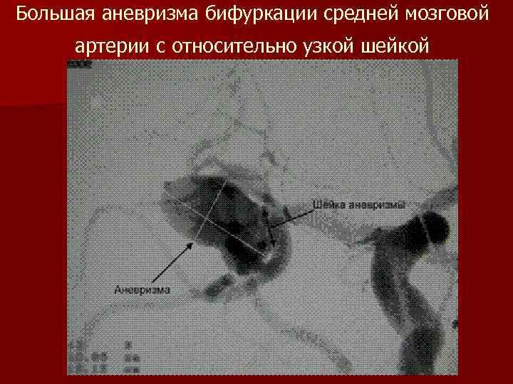 Большая аневризма бифуркации средней мозговой артерии с относительно узкой шейкой 