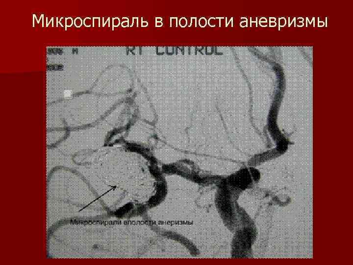 Микроспираль в полости аневризмы 