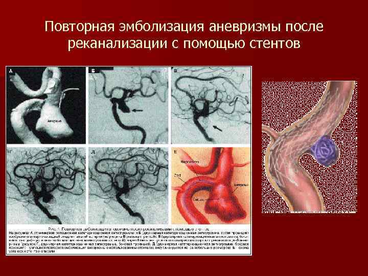 Повторная эмболизация аневризмы после реканализации с помощью стентов 