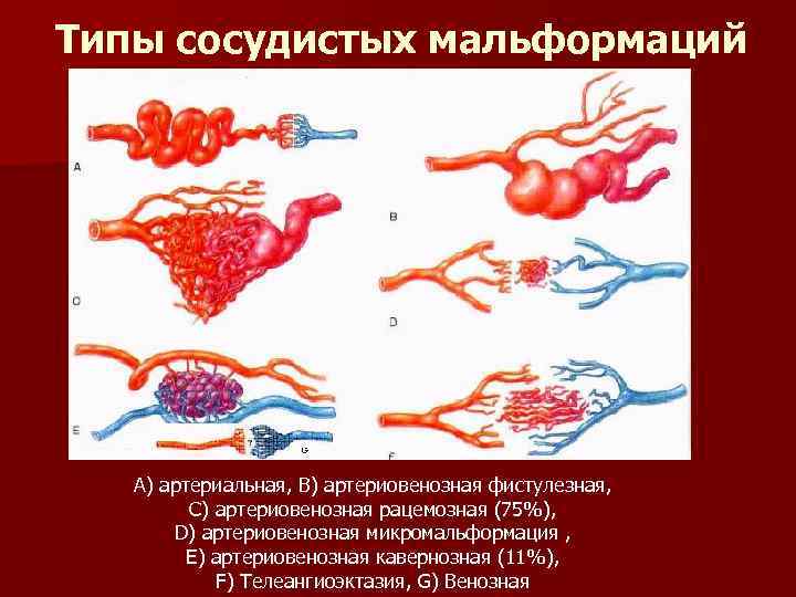 Типы сосудистых мальформаций А) артериальная, В) артериовенозная фистулезная, С) артериовенозная рацемозная (75%), D) артериовенозная