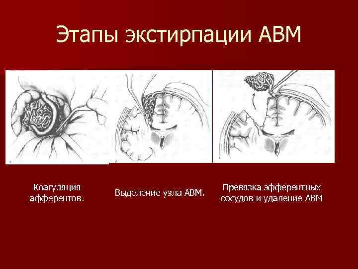  Этапы экстирпации АВМ Коагуляция афферентов. Выделение узла АВМ. Превязка эфферентных сосудов и удаление