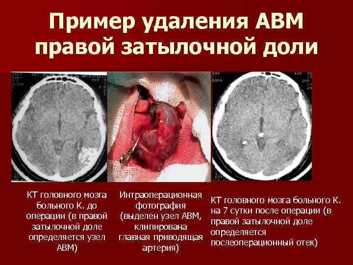  Пример удаления АВМ правой затылочной доли КТ головного мозга Интраоперационная КТ головного мозга