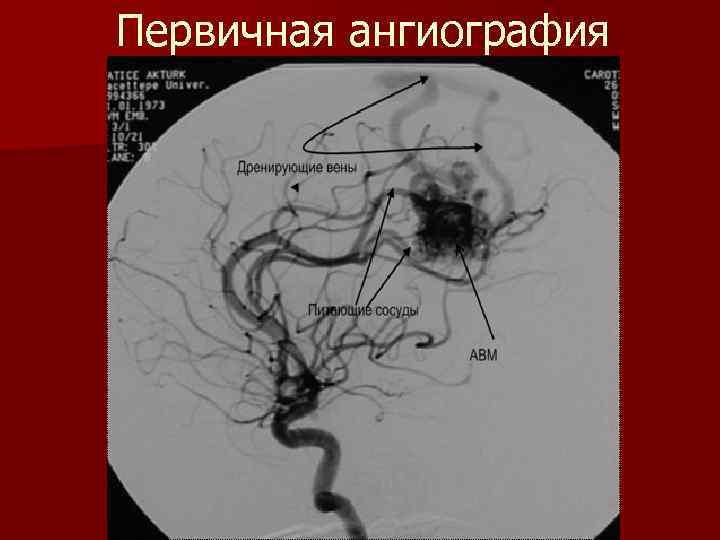 Первичная ангиография 