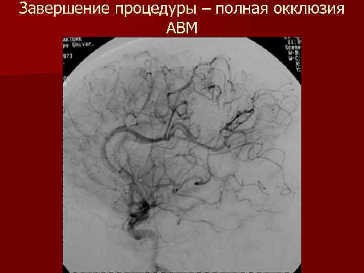 Завершение процедуры – полная окклюзия АВМ 