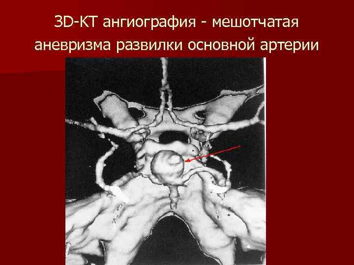 ЗD-KT ангиография - мешотчатая аневризма развилки основной артерии 