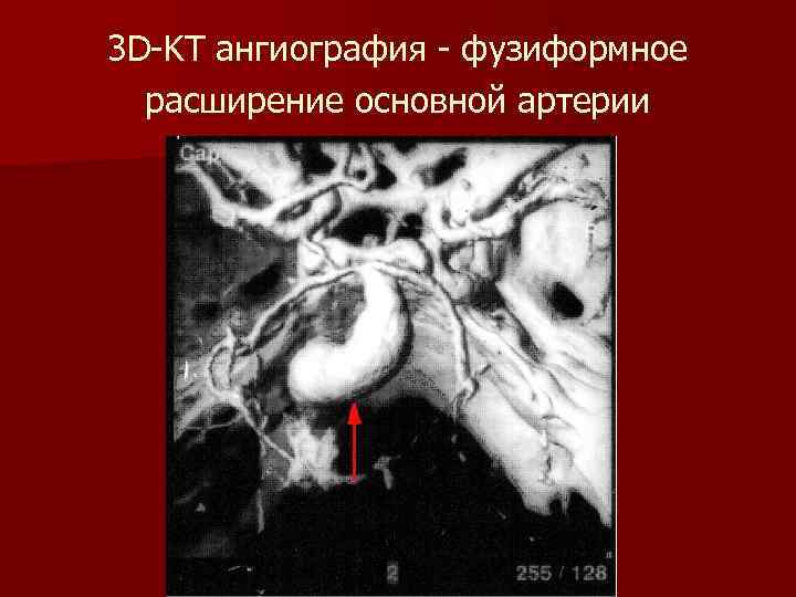 3 D-KT ангиография - фузиформное расширение основной артерии 