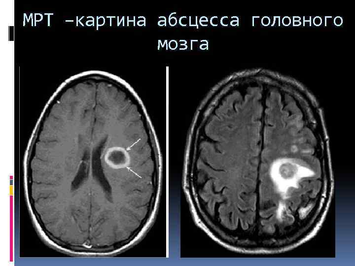 МРТ –картина абсцесса головного мозга 