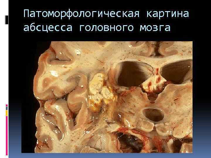 Патоморфологическая картина абсцесса головного мозга 