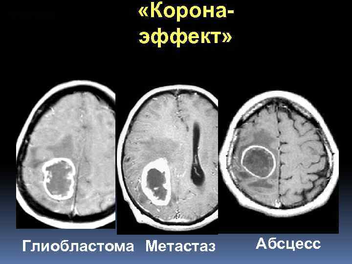  «Коронаэффект» Глиобластома Метастаз Абсцесс 