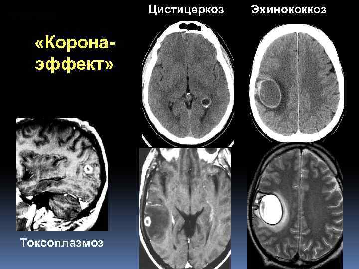 Цистицеркоз «Коронаэффект» Токсоплазмоз Эхинококкоз 